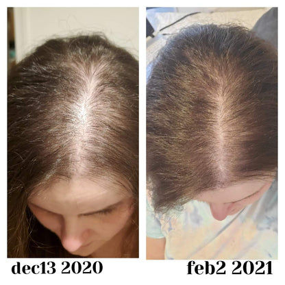 Baby Blues Postpartum Hair Loss Vitamins - Passion Fruit Gummies with Biotin, Collagen Baby Blues